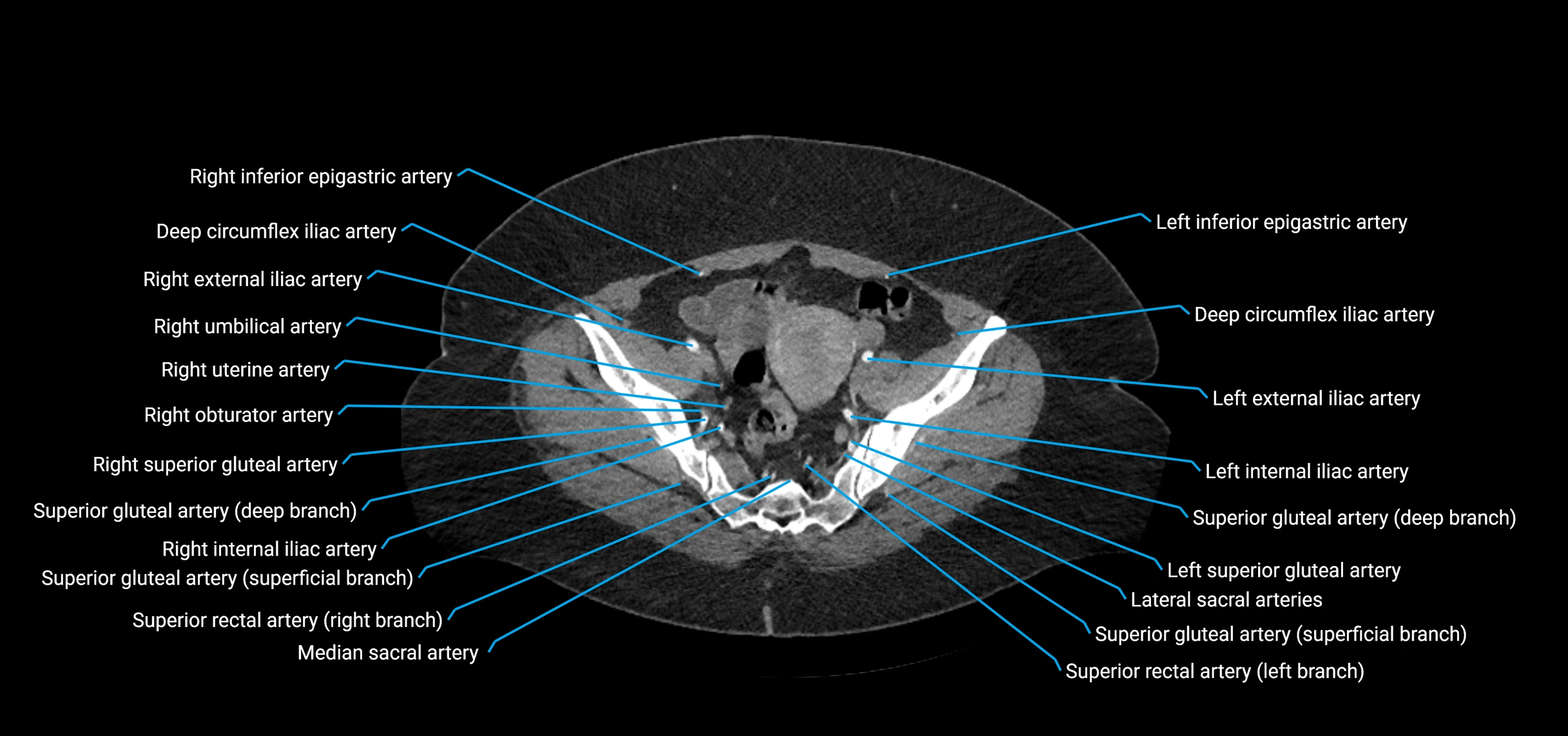 CTA abdomen axial cross sectional anatomy labelled image_208 (2).webp